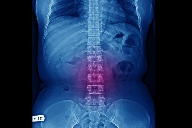 רנטגן- היצרות תעלת עמוד השדרה